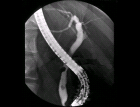 images/thumbs/Fall1ERCP.png